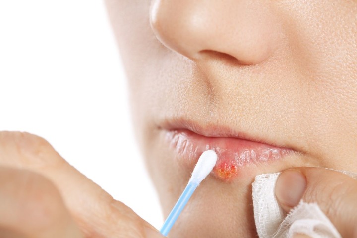 Herpes labial remedios cura cuidados para el herpes labial