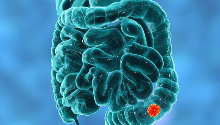 La diverticulitis depende también de la edad