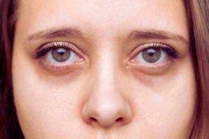 rostro de mujer con ojeras